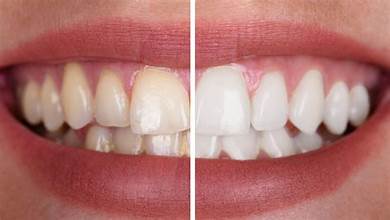 Dental Bonding Before and After
